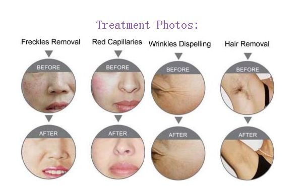 HR950B IPL E-light SHR hair removal.jpg HR950B IPL E-light SHR hair removal.jpg