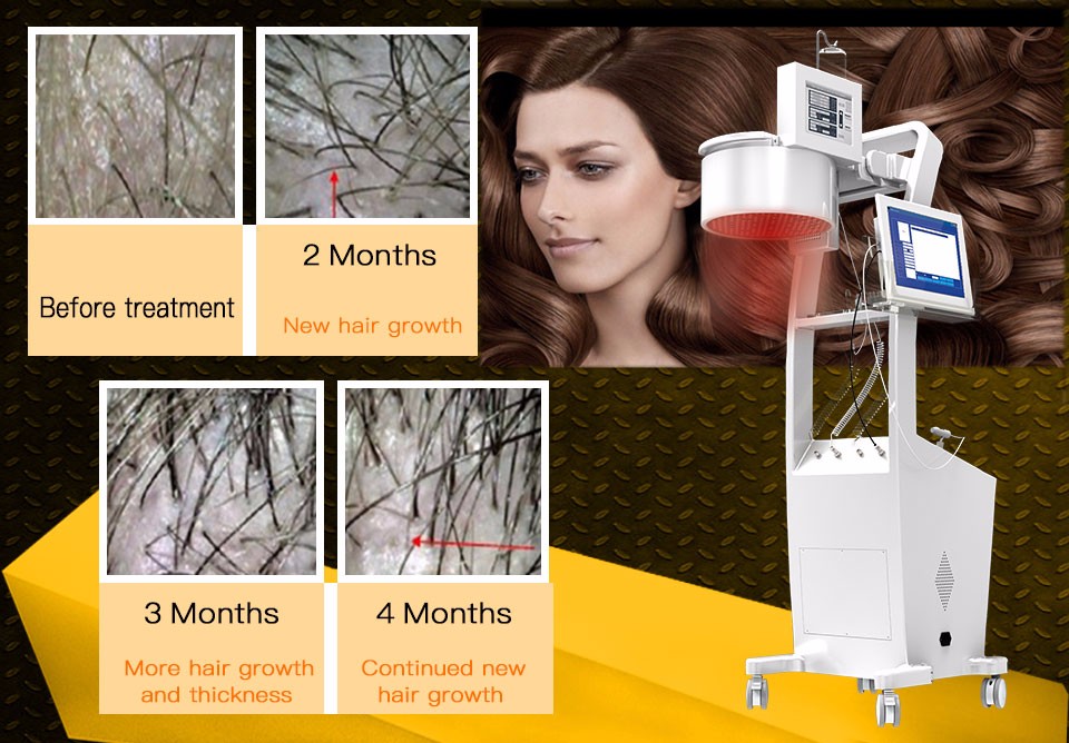 2018Newest Laser Hair Regrowth Machine 2018Newest Laser Hair Regrowth Machine