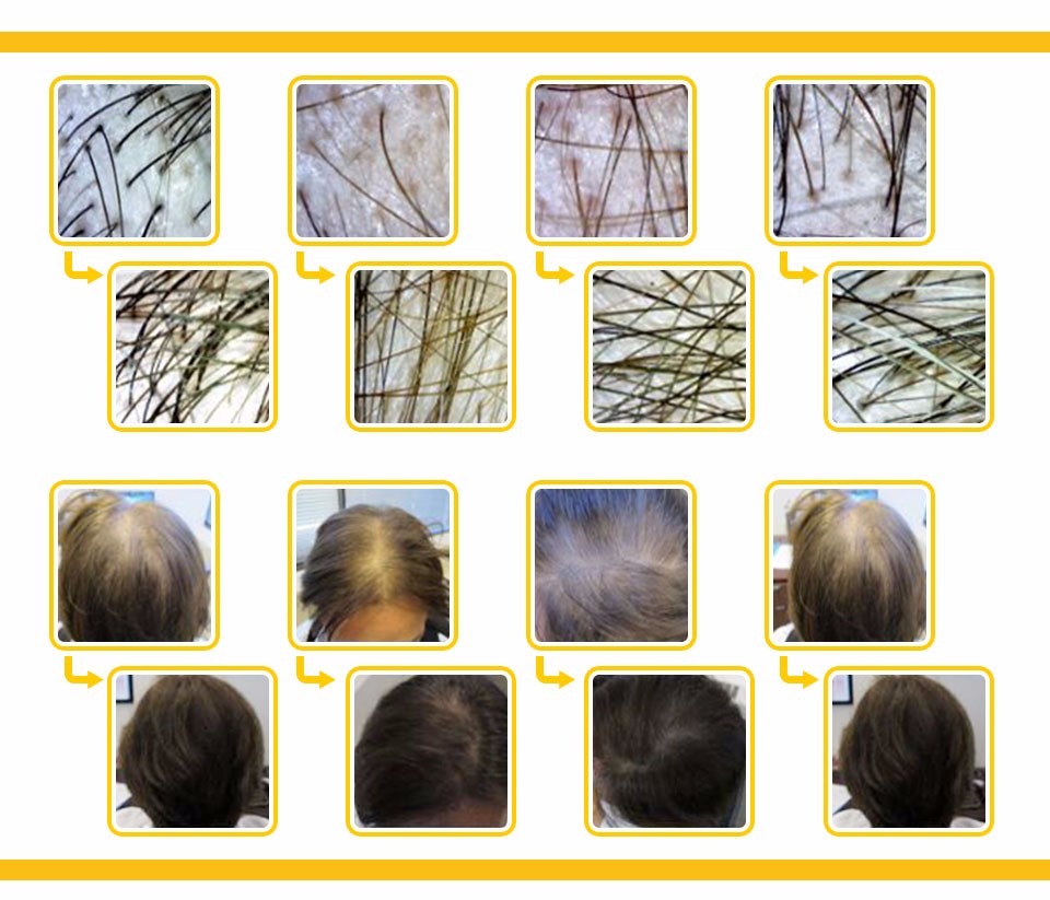2018Newest Laser Hair Regrowth Machine 2018Newest Laser Hair Regrowth Machine