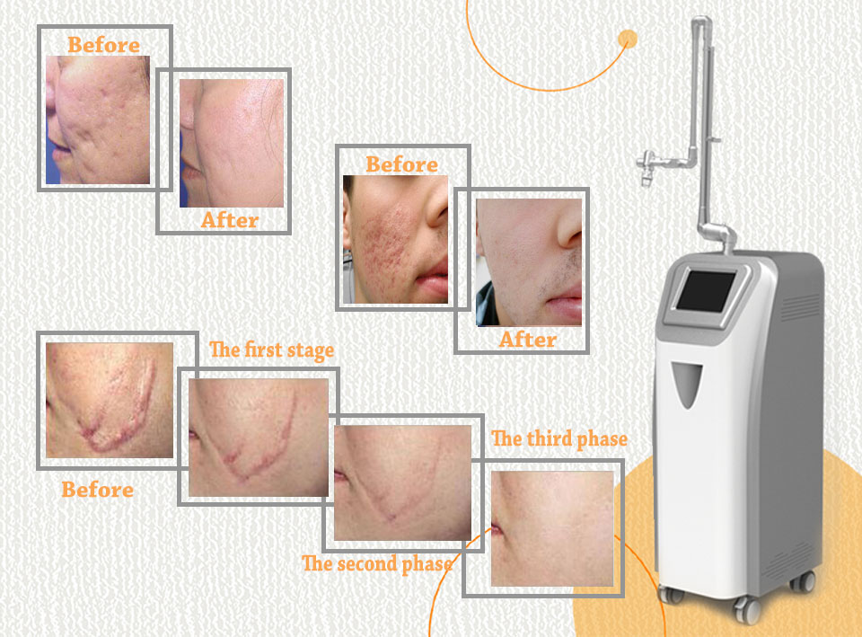 CO2 Laser Skin Treatment Stretch Mark Removal Machine