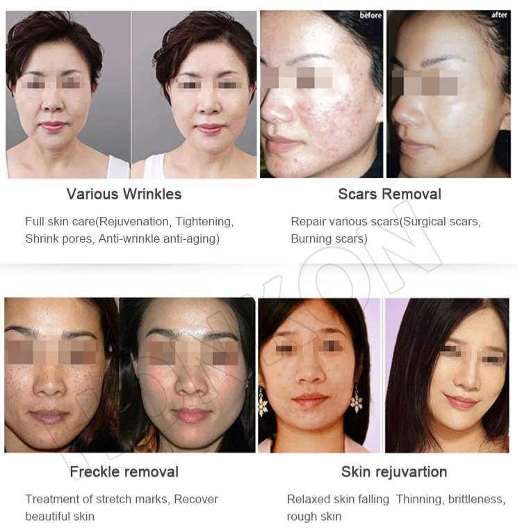 CO2 Laser Skin Treatment Stretch Mark Removal Machine