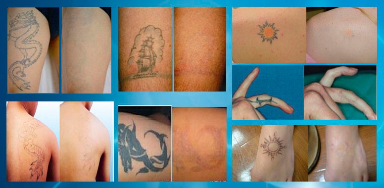 Picosecond Technology Pico Laser Tattoo Removal Machine