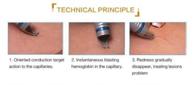 980nm Diode Laser Vascular Removal Device Factory Price 980nm Diode Laser Vascular Removal Device Factory Price